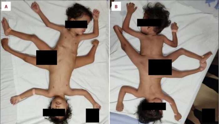 『다리 3개 팔 4개』 희귀 샴쌍둥이…3년간 못 앉았다, 무슨 사연?