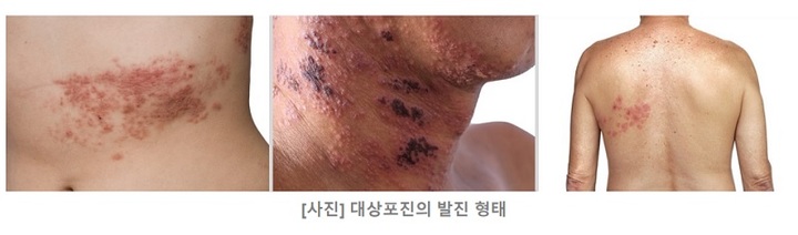 『감기 몸살인줄 알았는데 대상포진』…골든타임은 72시간[몸의경고]